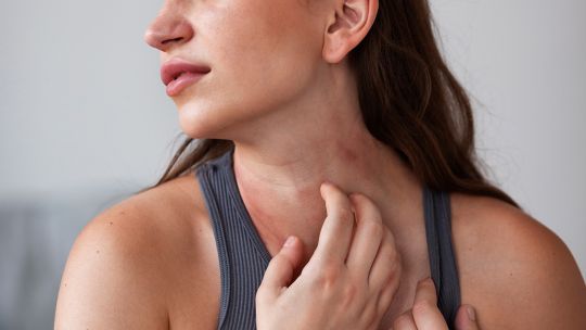 Imagen para el artículo: Alerta por dermatitis atópica en Argentina: advirtieron sobre demoras de hasta cinco años en el diagnóstico certero