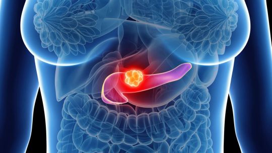 Imagen para el artículo: Cáncer de páncreas: una píldora duplica la supervivencia de pacientes graves