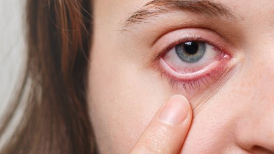 Imagen para el artículo: Invierno, pantallas y calefacción: una combinación que dispara los casos de “ojo seco”